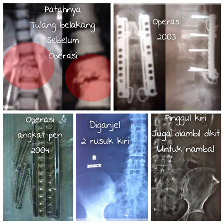 xrayde